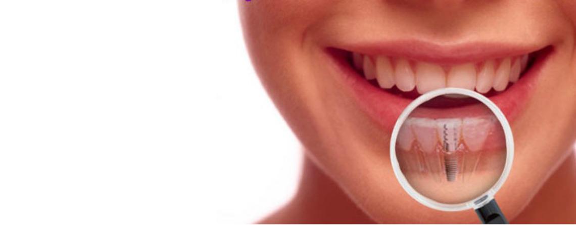 implantes dentales